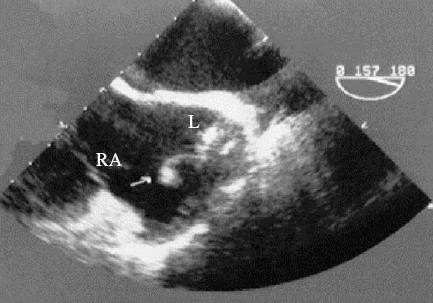 Εκβλάστηση Dumont, et al. European Heart Journal 2003;24:1779. Αντιμετώπιση α. Αφαίρεση της συσκευής β.