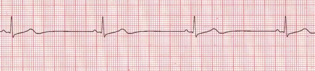 Bradicardia sinusală Ritm < 60/min ECG = normal Cauze: Fiziologice: vârsta, atleţi, sarcină, vagotonie Toxice: digitală, β-blocante, calciu-blocante, antiaritmice Boli non-cardiace: