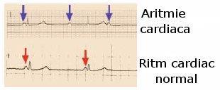 Definiţie: Anomalii ale ritmului cardiac derivate din tulburări ale