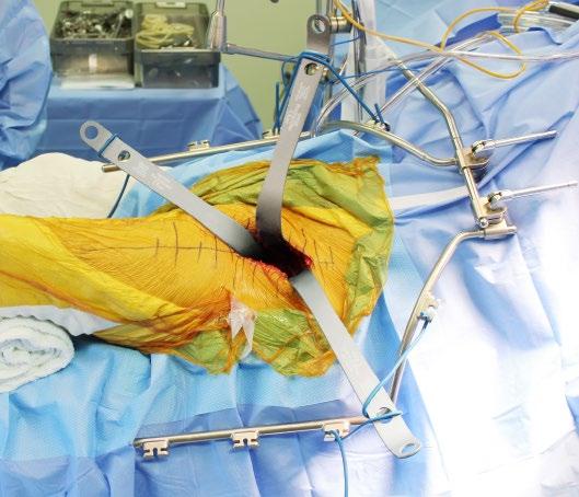 Step 6: Blade Placement (Acetabulum) Choose the appropriate retractor