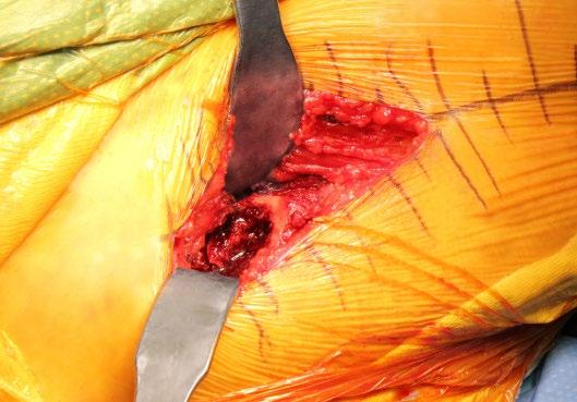 Step 8: Femur Elevation Visualization of the proximal femur may be achieved using