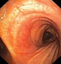 Complicatii: Complicatii locale imediate: Fistulizarea ganglionara intr-o bronsie risc de obstructie bronsica acuta la copiii mici Bronhoscopie: fistula, aspirat bronsic bk + Tuberculoza pulmonara