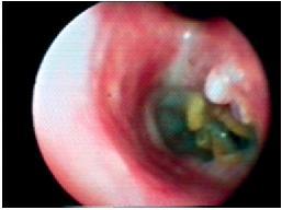 TUBERCULOZA PULMONARA PRIMO-SECUNDARA Rar la copilul mic La adolescent sau copilul mare in conditii de malnutritie Tablou clinico-radiologic cu cel al tuberculozei la adult (imagini cavitare)