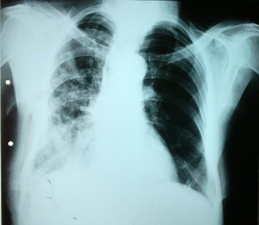 Tuberculom Alte leziuni