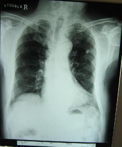 Criterii radiografice de suspiciune a tuberculozei Localizarea