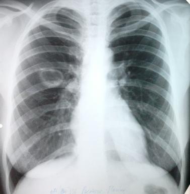 ! Diagnostic pozitiv al TB pulmonare la adult DA Manifestari clinice (tuse persistenta) Examen sputa bk Modificari Rgx compatibile Examen HP NU IDR la PPD Anticorpi antimicobacterieni Quantiferon