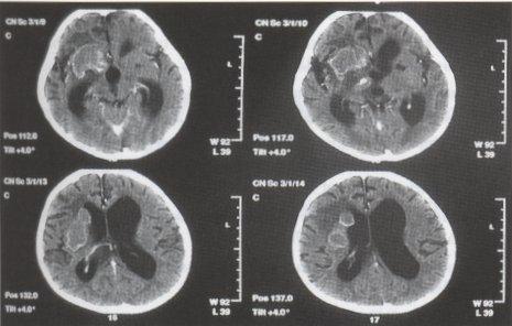 Alte localizari Tuberculoza peritoneala Evoluţie insidioasă Clinic: ascită; rareori abdomen acut Diagnostic: laparotomie exploratorie cu examen histologic + bacteriologic al fragmentelor peritoneale