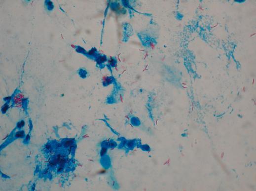 Examenul microscopic Coloratia Ziehl-Neelsen Standard Relativ laborioasa (in special citirea lamelor) frotiu de sputa ce arata pe langa celule si alte resturi colorate in albastru si numerosi BAAR
