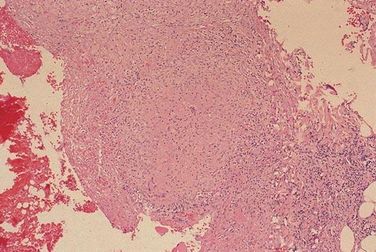 (alb) in interior * fragment pleural cu un