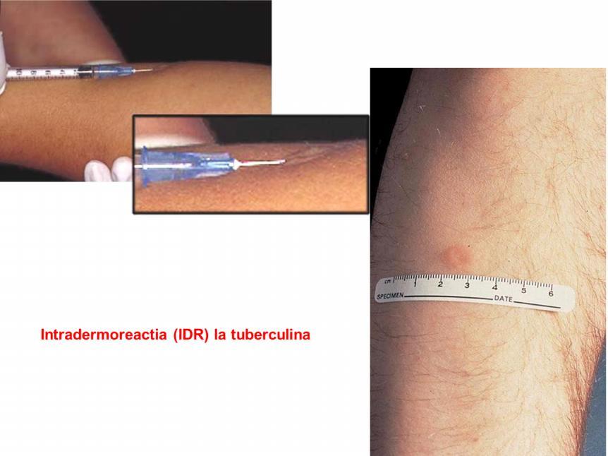 Testarea cutanata tuberculinica = injectarea strict intradermica de antigene din MTB (denumite PPD = derivat de proteina purificata) ce provoaca o reactie de hipersensibilitate intarziata ce consta