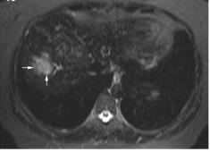 Εικόνα 5. Απεικόνιση ηπατικών αγγειακών ανωμαλιών και δυσπλασιών μέσω ηπατική MRI. Η πρώτη εικόνα δείχνει μια υπερογκώδη μάζα που αφοροά μία αγγειακή δυσπλασία (άσπρα βέλη).