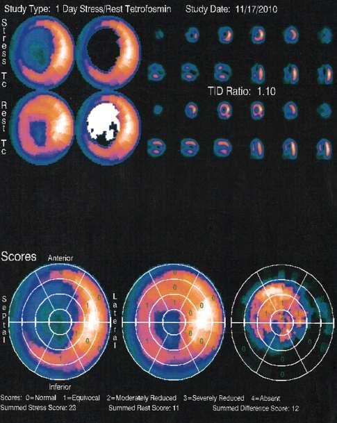 Large ischemia