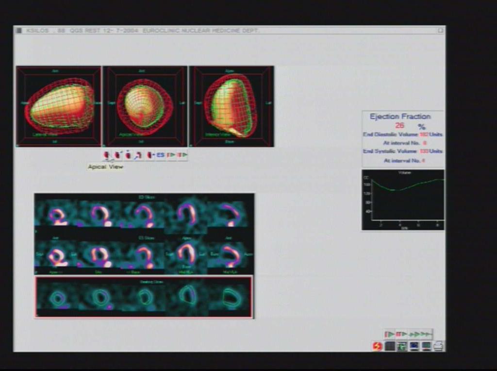 Global and regional assessment of LV fx with gated SPECT I.