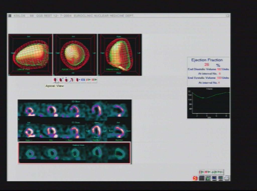 Global and regional assessment of LV fx with gated SPECT I.