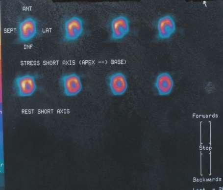 SPECT ηρεμίας : EF 65%,