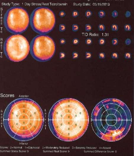 SPECT Q-analysis 77 με ιστορικο παλαιου