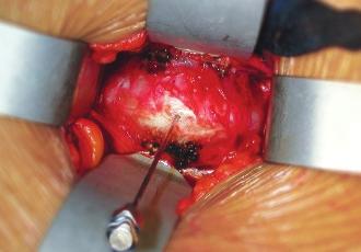He has performed over 1,500 open anterior approaches to the lumbar spine and has also been a pioneer in anterior laparoscopic and thoracoscopic access. Now retired, Dr.
