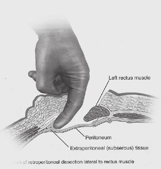 The level of the transverse incision in the craniocaudad plane depends on the level of the spine to be approached.