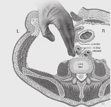 Sweep with the closed fist up and down to elevate the peritoneum away in all directions.