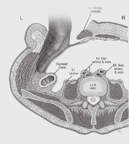 artery. This will expose the left common iliac vein just underneath the artery. Continue the dissection posteriorly to identify the ileolumbar vein(s).