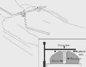Retroperitoneal Mini-Approach Set Up Steps ( continued ) Step 6 The lateral extension arms are attached to the crossbar (A) and positioned just above the horizon of the patient (B).