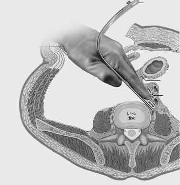 A Radiolucent Reverse Lip Anterior Spine Access blade is placed blindly on the right side of the spine using the finger(s) as a guide.
