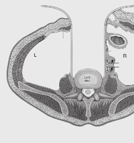 anterior surface of the spine. Once secured to the Thompson Retractor, the reverse-lipped blade will not move.