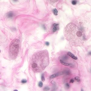 Tablou clinic Amibiaza extraintestinală Abces hepatic amibian Hepatomegalie dureroasă la ~ 3S după diaree sanguinolentă Puroi de culoare maronie-ciocolatie (catabolizare