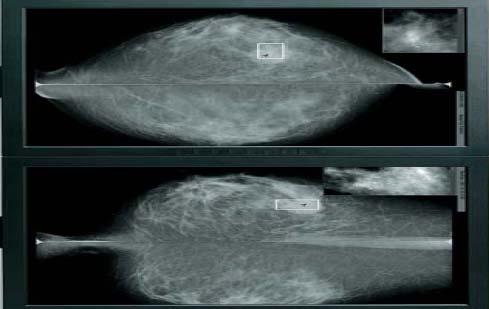 General Radiology (Coronis 3MP) Mammography (Coronis 5MP mammo) Resolution 2048 x 1536