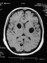 Αλβενδοζόλη και κορτικοειδή Preferred Consensus Schemes Cystic, intraparenchymal