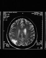 (consensus if many enhancing lesions).