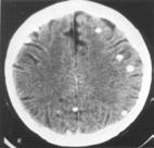 Preferred Consensus Schemes Calcified NCC 4 Consensus No