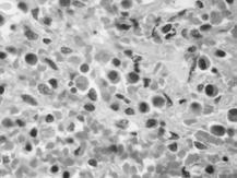 υποδόριο με γιγαντοκύτταρα ιστιοκύτταρα,