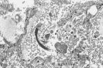 Σπλαχνικήκαιοφθαλμικήμεταναστευτικήπρονύμφη (Toxocara) Δερματική larva migrans (Angylostoma) Γναθοστομίαση (Gnathostoma) Φιλαριάσεις