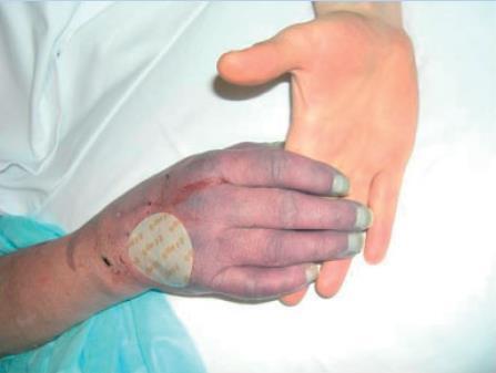ΦΑΙΝΥΝΤΟΪΝΗ Προσοχή στη χορήγηση Αργή ενδοφλέβια έγχυση για αποφυγή διαταραχών καρδιακού ρυθμού, υπότασης, αναπνευστικής καταστολής Purple Glove Syndrome