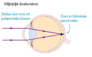 Anomalije oka kratkovidost Zraci svetlosti formiraju lik ispred mrežnjače i nastavljaju divergirati prema mrežnjači gde