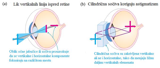 Anomalije oka astigmatizam defekt oka kod kojeg je površina rožnjače nepravilna - nije sferna nego je zakrivljena u jednoj ravni više nego u drugoj, zbog čega osoba vidi zakrivljene