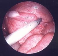 ΛΑΠΑΡΟΣΚΟΠΗΣΗ Εντόπιση του ενδοκοιλιακού όρχι και δυνατότητα αποκατάστασης Non palpable testis laparoscopy for