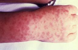 rash involving the sole of