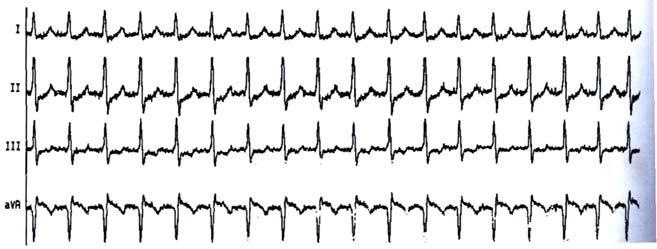 Fig. 8 Tahicardie atrială cu conducere AV 1:1 (după C.