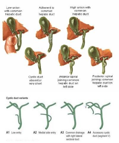παράλληλη πορεία με το χοληδόχο πόρο απόν ή πολύ βραχύς με ευρεία εκβολή στον κοινό ηπατικό