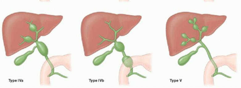 διάταση του χοληδόχου πόρου: τύποι Ι-V (επιπλοκές: λοίμωξη, χολική ίνωση, παγκρεατιτιδα, π.