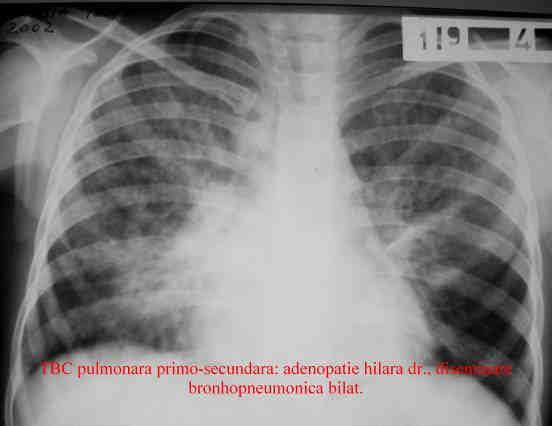 Formele maligne sunt identificate drept categorie diagnostică aparte sub numele de forme grave de tuberculoză la copil.