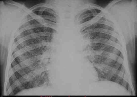 Fac parte din această formă clinică, pneumoniile şi bronhopneumoniile cazeoase, miliara şi meningo-encefalita TB, precum şi alte forme de tuberculoză extrapulmonară.