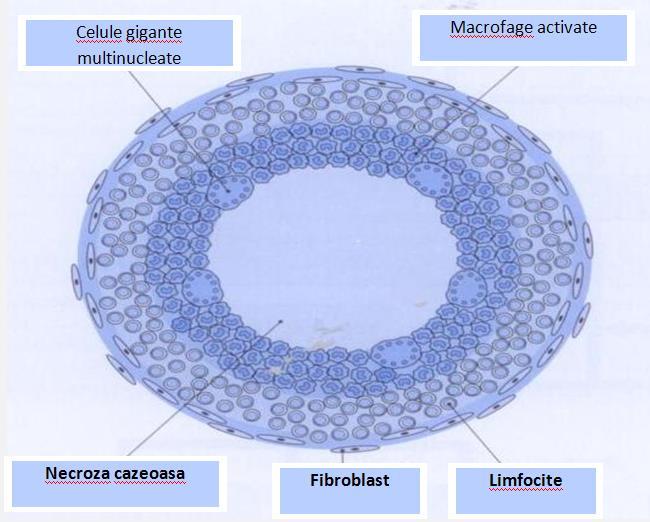 Un granulom, care arată acumularea tipic focala de limfocite și macrofage în jurul unei