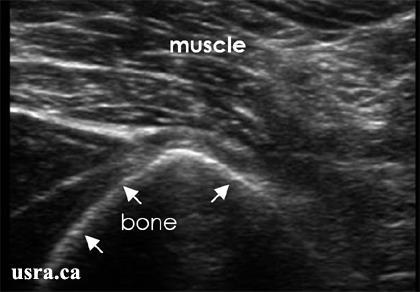 Εικόνα 4. Ο μυς είναι επίσης υποχογενής ιστός με ραβδώσεις υπερηχοειδείς.