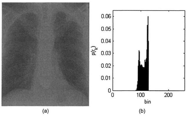 a) Μια ασπρόμαυρη (gray - scale) εικόνα ακτίνων X χαμηλής αντίθεσης b) το ιστόγραμμα της εικόνας a. Πηγή: http://what-whenhow.