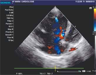 G, 11 zile: ecocardiografie apical 4 camere anomalie Ebstein formă severă D-TRANSPOZIŢIA VASELOR MARI Se defineşte prin discordanţa ventriculo-atrială, în sensul că aorta emerge din ventriculul drept