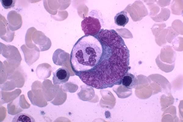 Αιμοφαγοκυτταρικό Σύνδρομο Χαρακτηρίζεται από πανκυτταροπενία στην περιφέρεια ενώ στο μυελο υπάρχει φαγοκυττάρωση ερυθρών, κοκκιοκυττάρων και αιμοπεταλίων από μακροφάγα Ο μυελός είναι