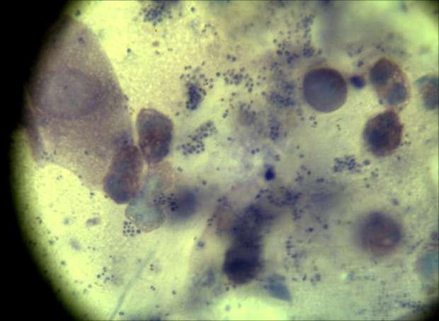 PACIENŢI SI METODE Secreţie uretrală examinată la microscopul cu
